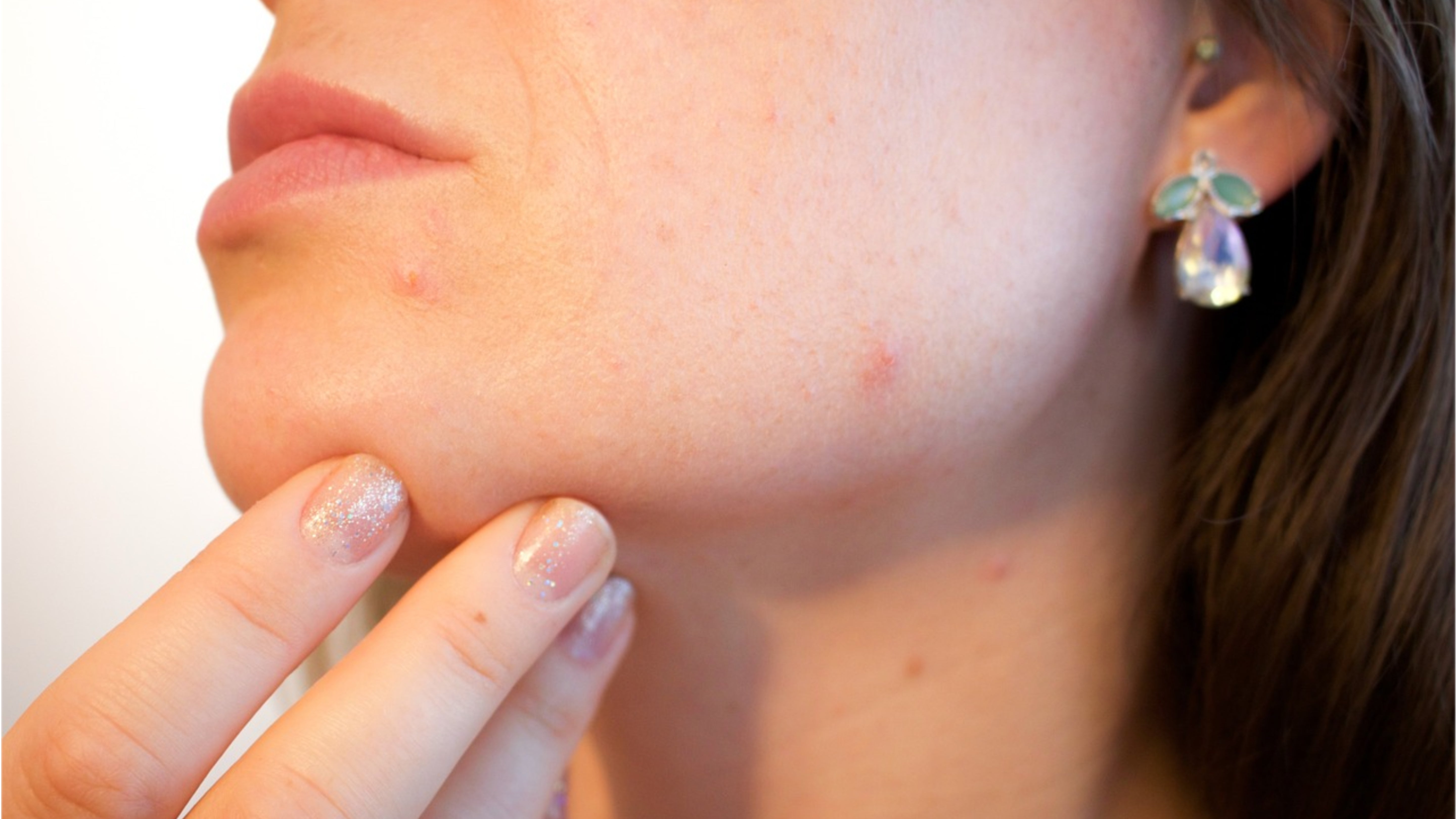 How to Get Rid of Acne Scars Fast