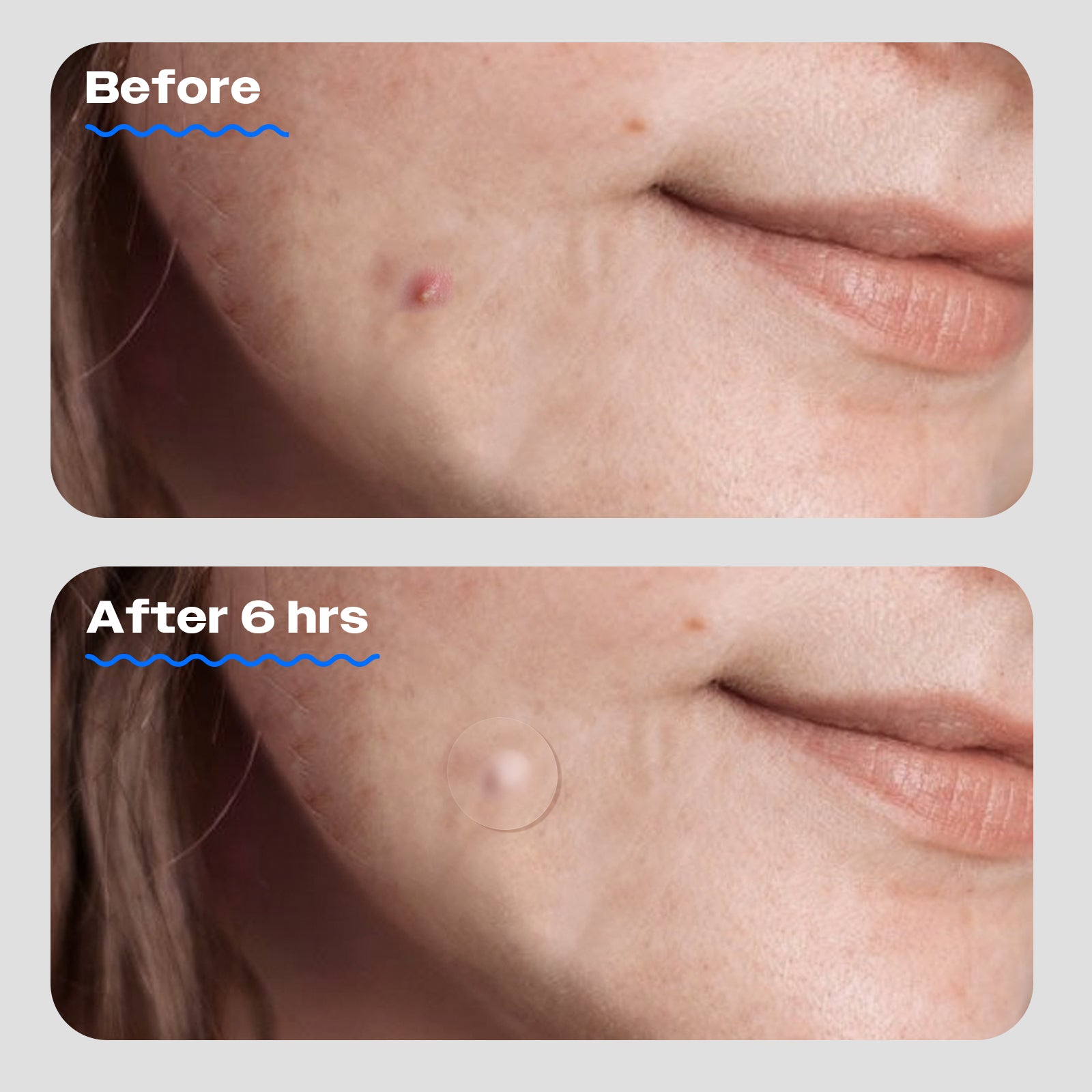 Acne Cover Patch Original 80CT – Avarelle Cosmetics